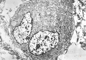 M,29y. | testis - embryonal rhabdomyosarcoma in teratoma